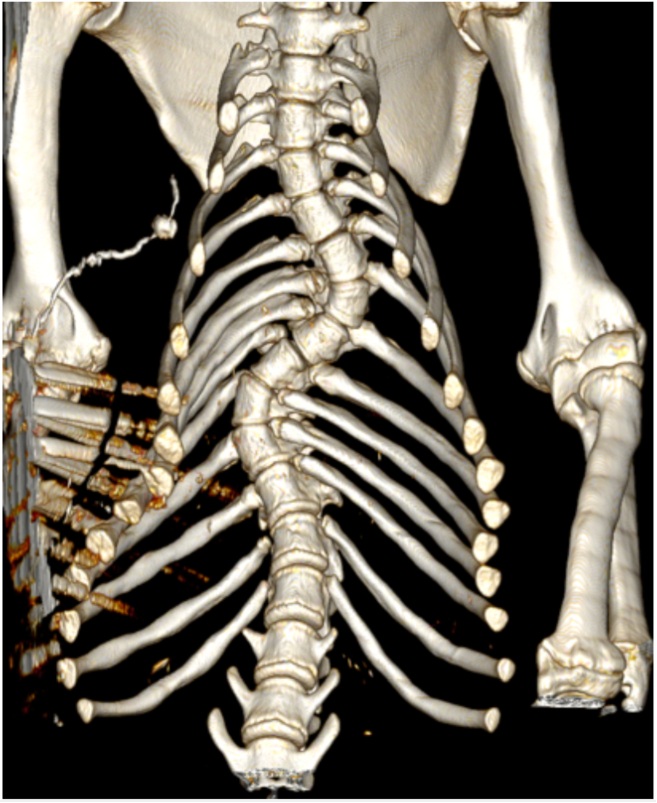 Scan of a spinal cord